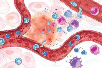 Действие на босвелия върху възпалени участъци от тялото